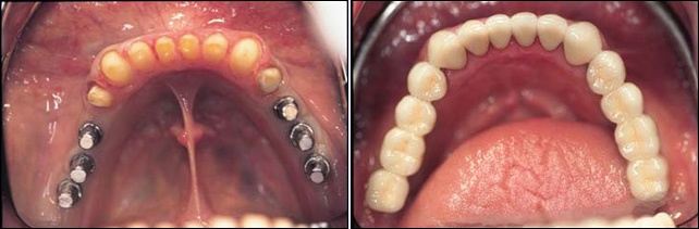 Dental Implants Case 21