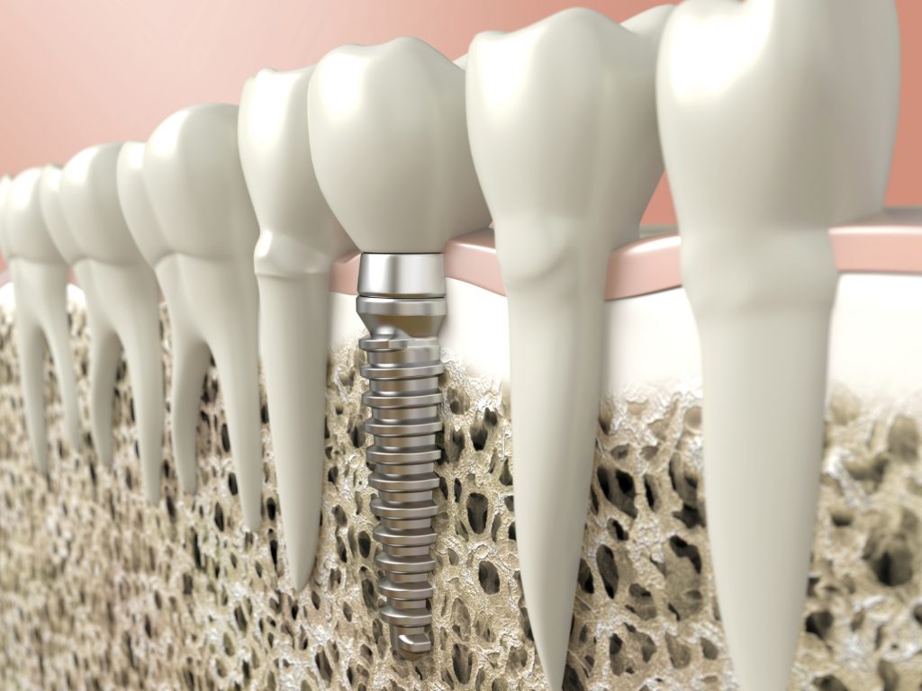 Dental Implants Dominican Republic Source of Quality Dentistry